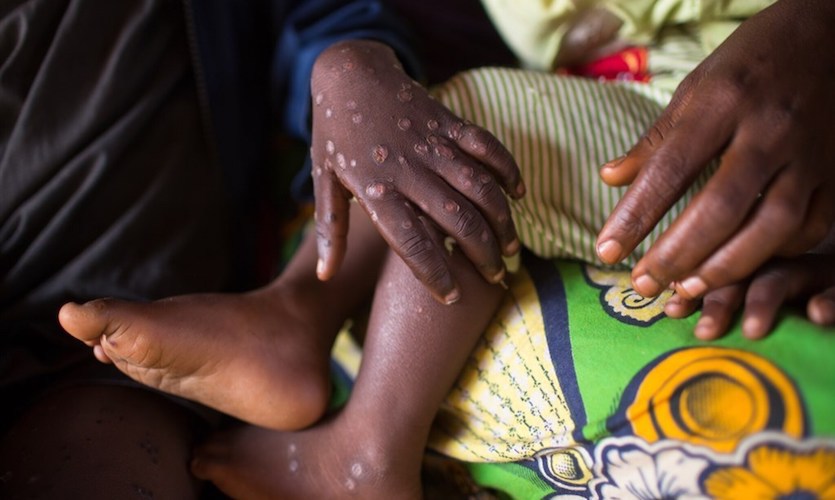 Explained: What Is Monkeypox?